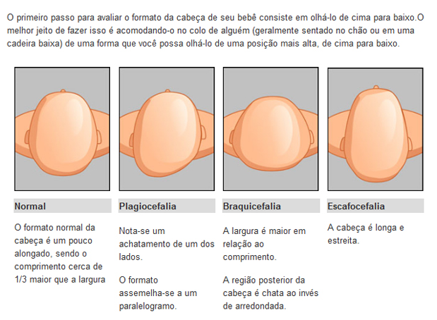 Braquicefalia ou cabeça achatada: Atenção com a cabeça do bebê
