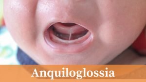 anquiloglossia